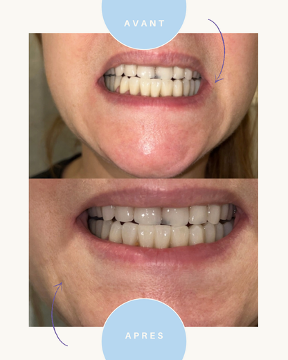 BELLISMILE - Sérum correcteur booster de blancheur